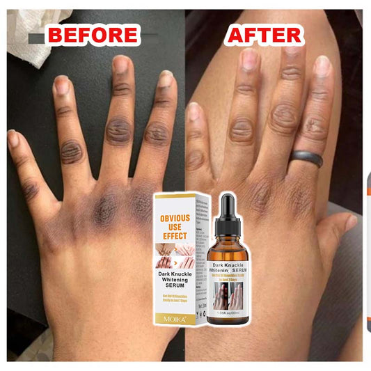 ✅Dark-Knuckle Serum (100% Guarantee)