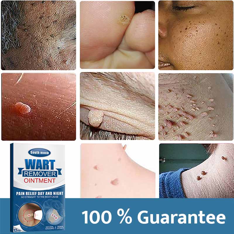 ✅ मुसा,कोठी हटाउने 12 pcs Wart-Remover Patch